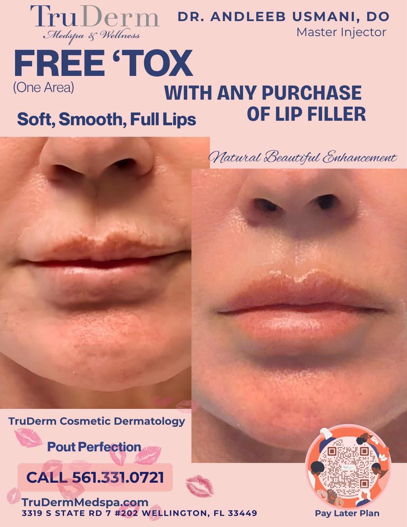 Natural Lip Correction Before After