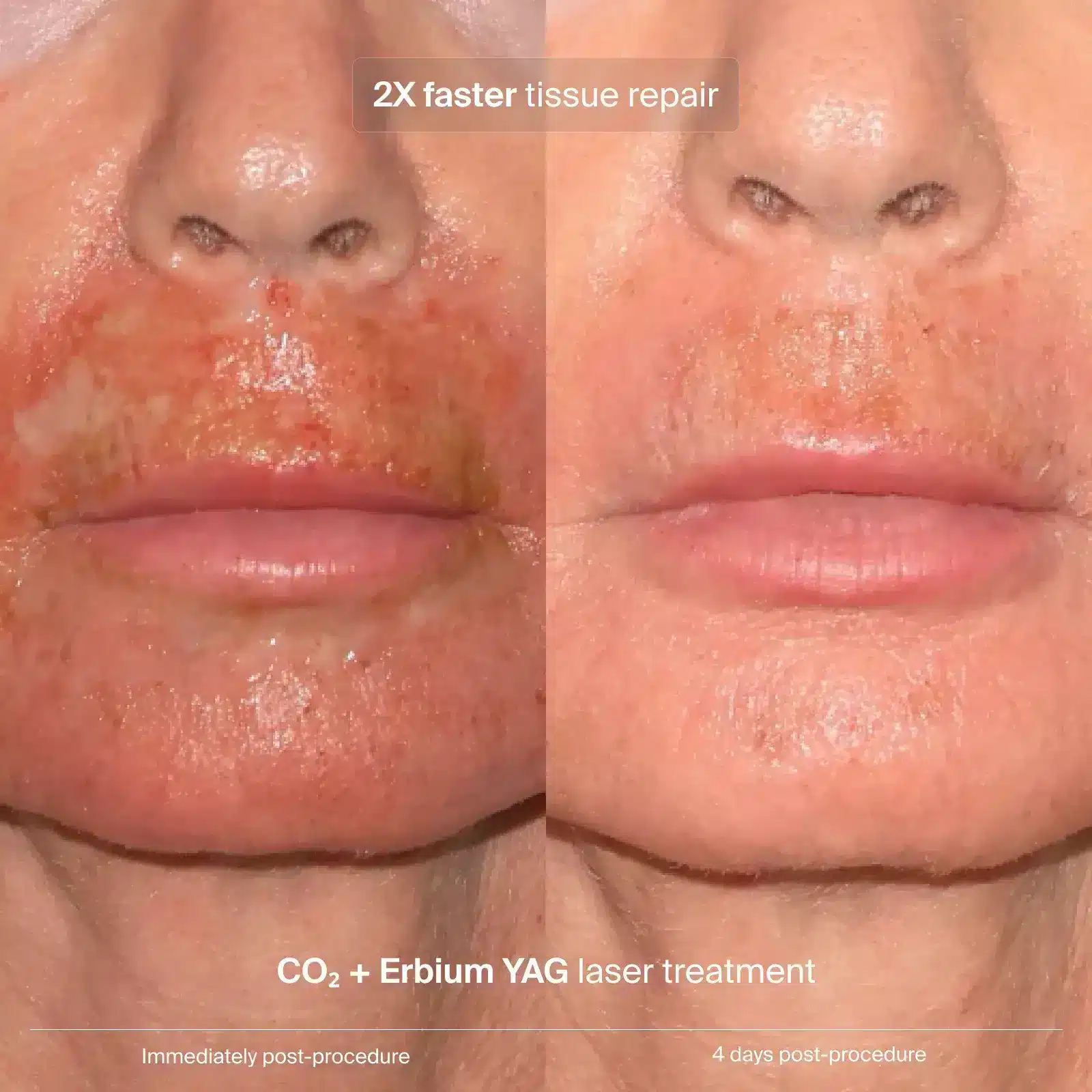 Pavise Extracellular Matrix Restore After laser Yag treatment