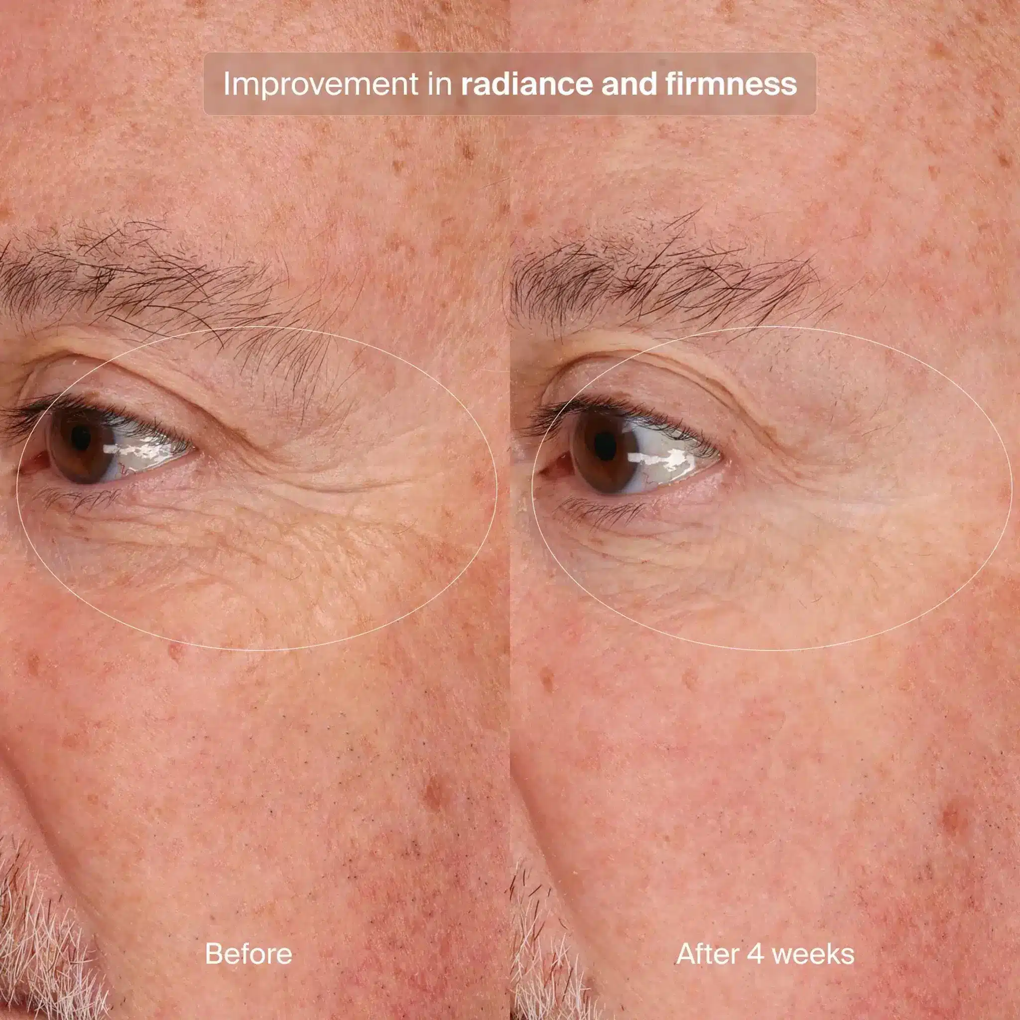 Pavise Precision Eye Lift Before After 1