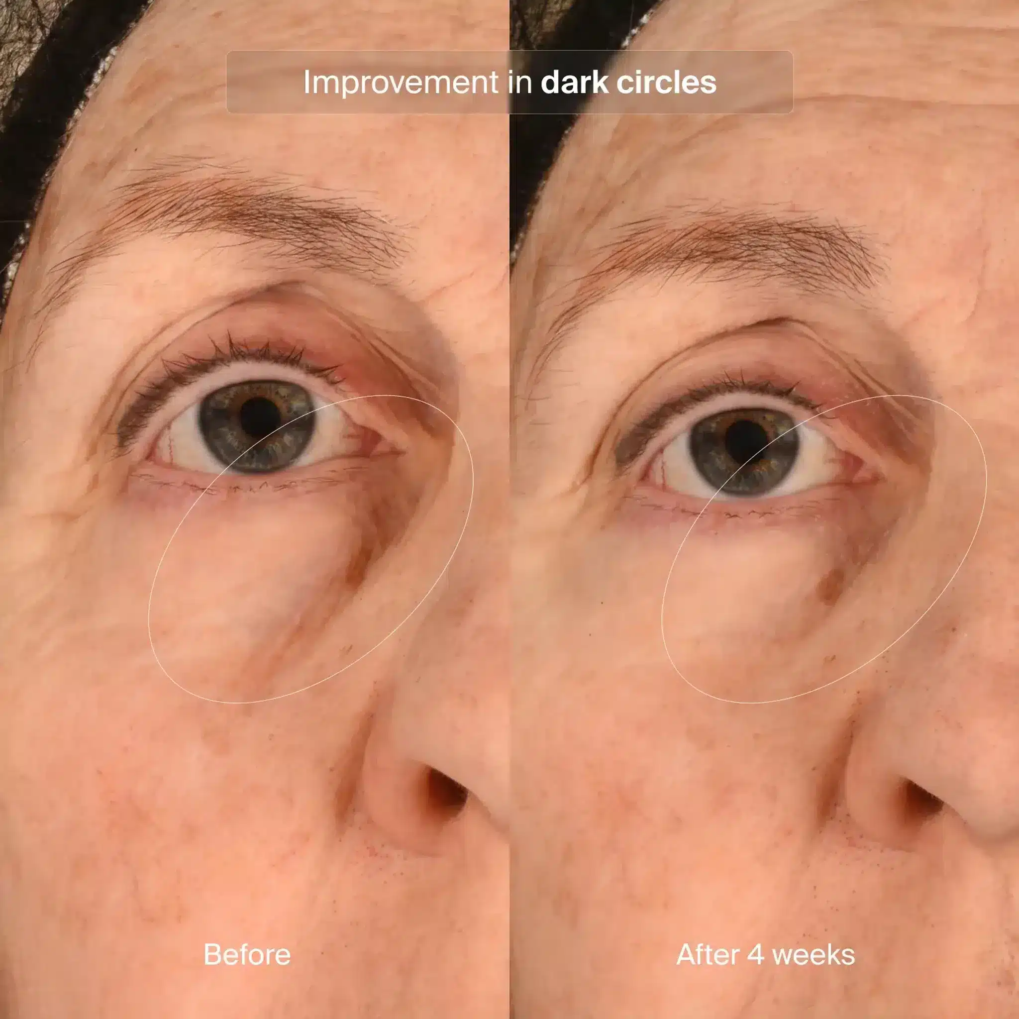 Pavise Precision Eye Lift Before After 3