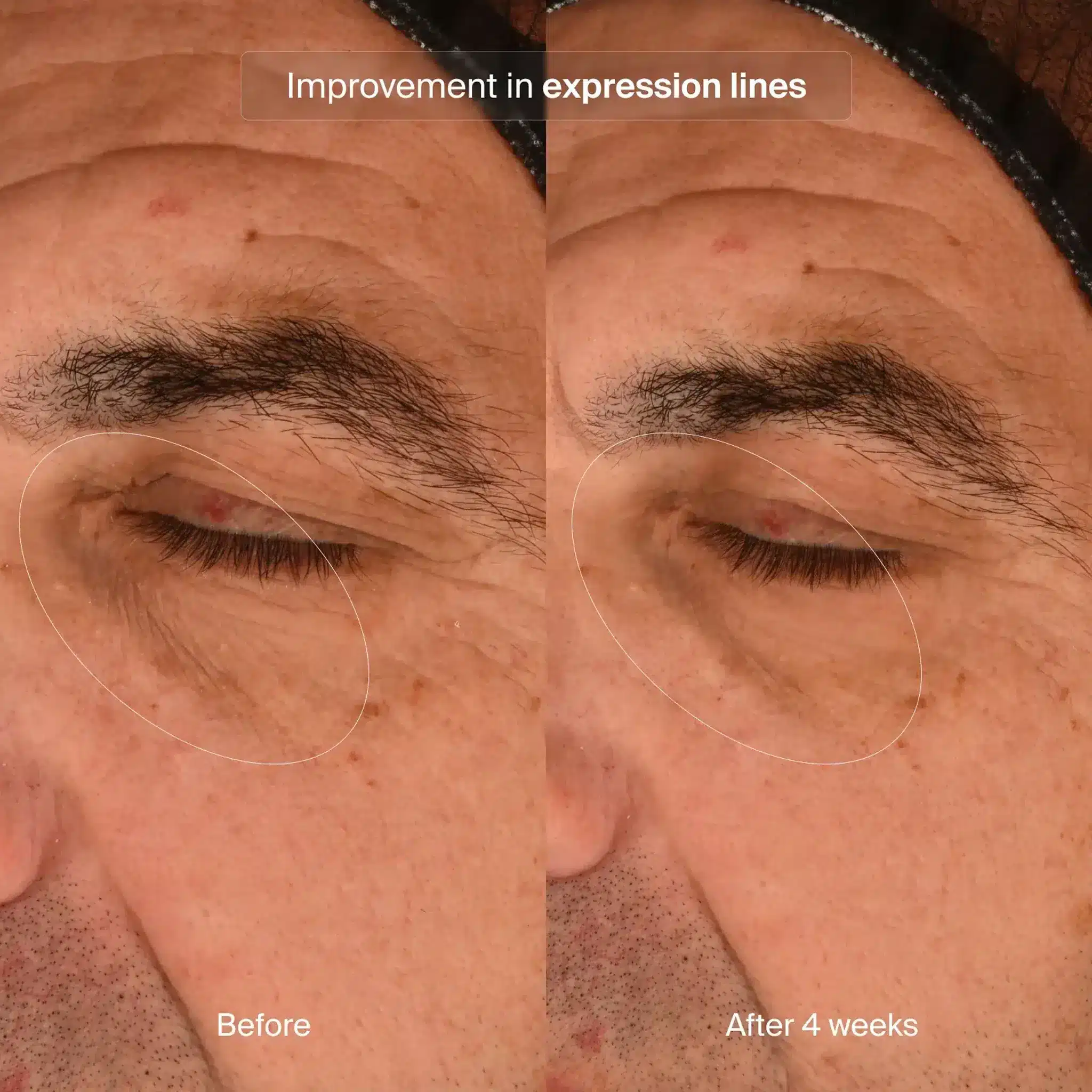 Pavise Precision Eye Lift Before After